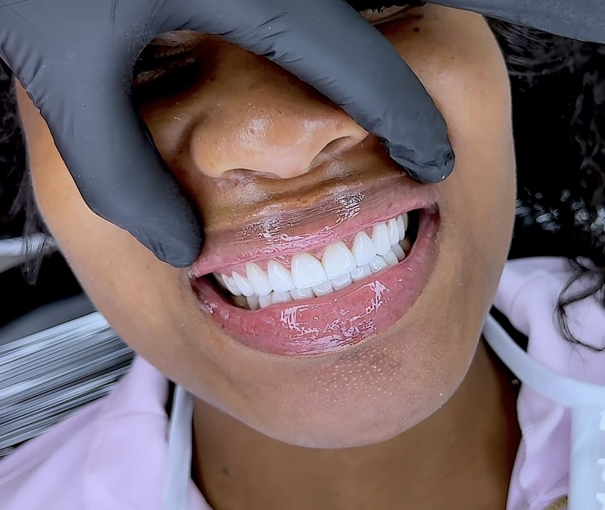Cosmetic Dentistry at EverSmile Dental Care